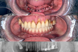 Dentist Crangasi Bucuresti Remis Constantin - Implant Dentar - Fast And Fixed Proteza Fixa / Dantura Fixa 24h